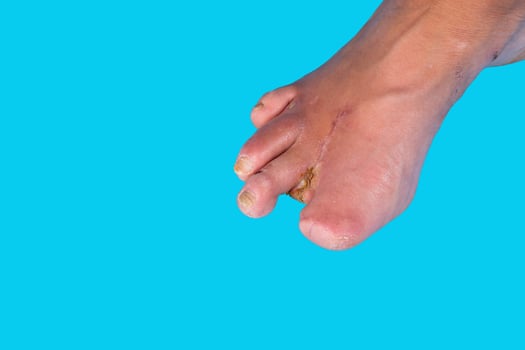 Amputation of diabetic toes of a person on a blue background. Selective focus. photo