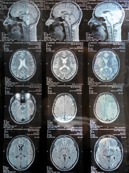 MRI of the human brain of a patient with multiple sclerosis of the initial stage. Close-up X-ray vertical photo