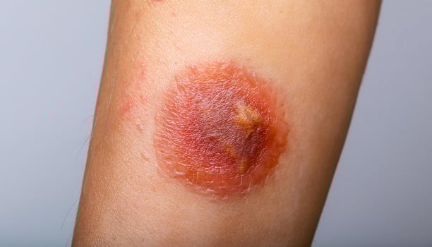 detailed close-up of ringworm lesion on the forearm showing a red circular patch with inflamed edges and scaly center photo