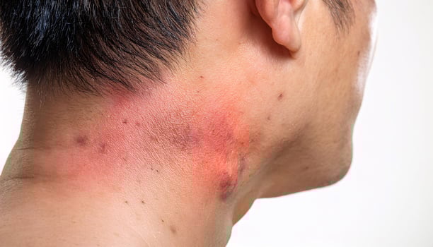 detailed shot of allergic contact dermatitis on the neck showing redness, inflammation, and irritated skin texture photo