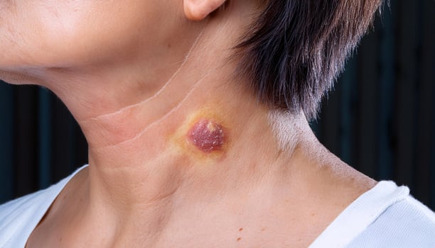 close-up of ringworm lesion on the neck with raised, red, and scaly border, detailed dermatological infection on human skin photo