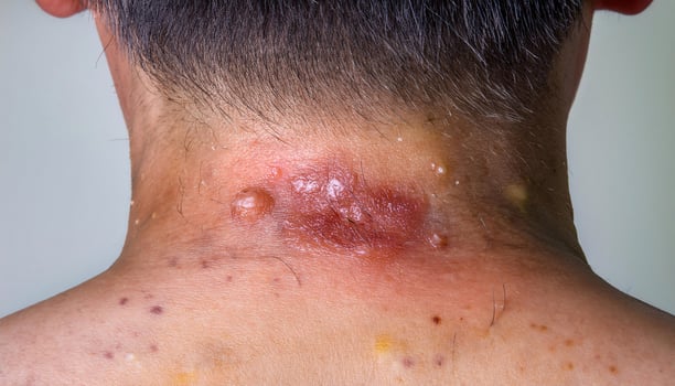 close-up of infected ringworm lesion on neck with raised red and inflamed border, fungal skin infection with pus-filled blisters photo
