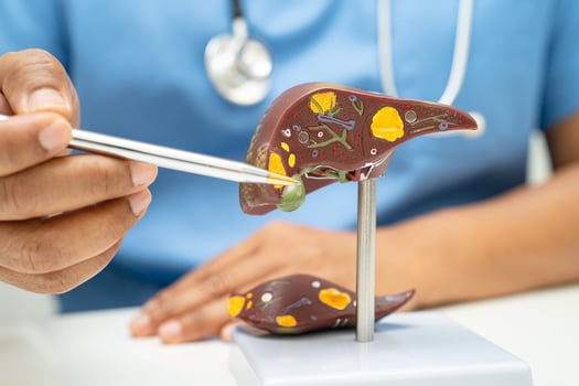 Cirrhosis, Liver cancer, fatty liver, Asian doctor with liver human anatomy model in World Hepatitis Day at hospital. photo