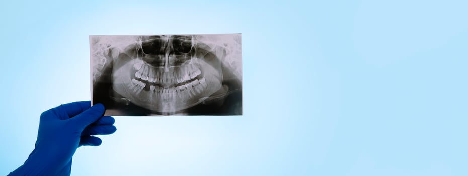 dentist holding snapshot the patient's tooth photo