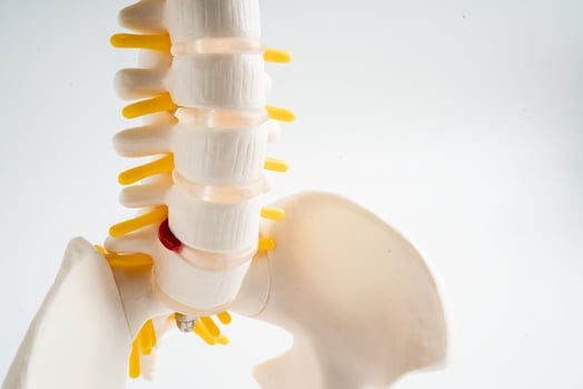 Lumbar spine displaced herniated disc fragment, spinal nerve and bone. Model for treatment medical in the orthopedic department. photo