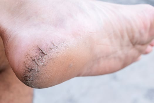 Close up cracked heel further deep cracks and dry flaky skin photo