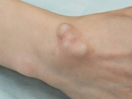 Big cyst hygroma, fluid filled lump associated with a joint, a tumor or swelling on top of a joint. photo