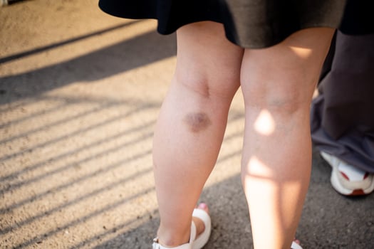A CloseUp Image of Bruised Legs While Wearing Summer Attire and Enjoying Outdoor Activities in the Sun photo