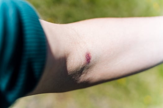 A closeup captures a healing arm injury on light skin in sunlight, symbolizing health and recovery. It highlights the bodys ability to recover from minor injuries photo