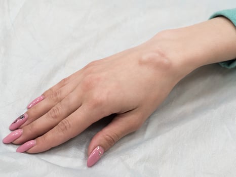 Big cyst hygroma, fluid filled lump associated with a joint photo
