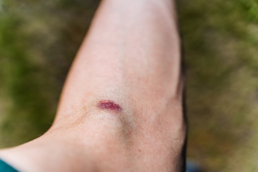 Documenting the gradual healing process of a bruise on the arm, this closeup highlights the different stages of injury recovery and the bodys natural response to trauma photo