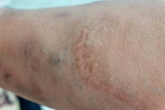 Skin disease of scabies infection caused by mites called Sarcoptes scabiei burrowing into leg skin. photo
