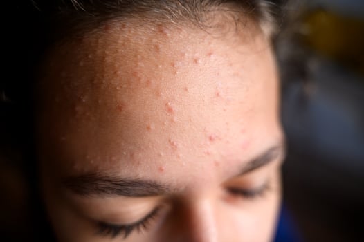 A teenage girl's forehead with akne blemishes photo