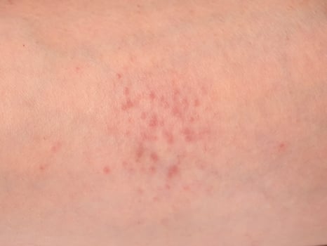 skin reactions on the skin on male forearm photo