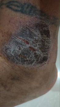black eczema skin disease on tattooed ankles photo