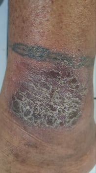 black eczema skin disease on tattooe ankles photo