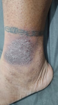 black eczema skin disease on tattoo ankles photo