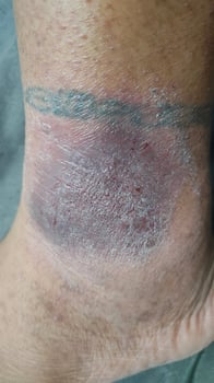 black eczema skins disease on tattooed ankles photo