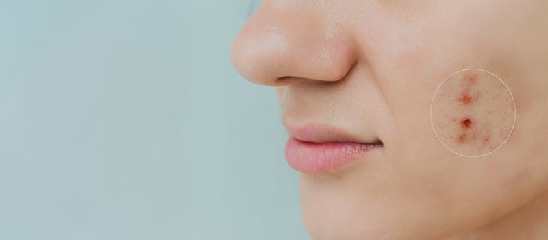 Close-up of a young girl with skin problems. Pimples, acne, pores, scars. Natural skin with and without filters. A place for your text. photo
