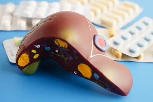 Liver model with pill drug treatment, Cirrhosis, Liver cancer, fatt photo