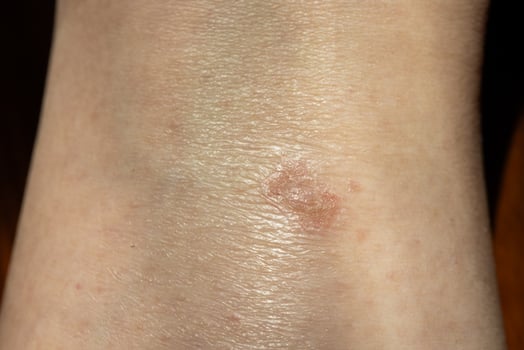 Eczema at Leg. Healthcare Concept photo