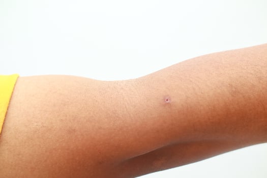 Minor skin lesion on forearm a close up of a small wound with visible inflammation on the human arm photo