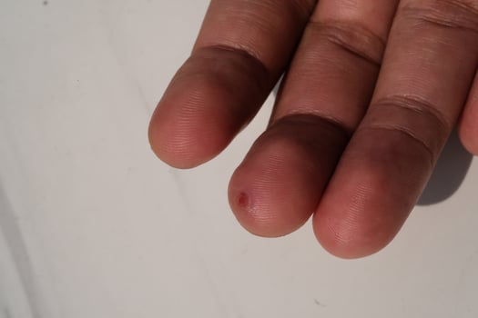 Injured middle finger skin. Wound on middle finger that started to heal after a few days. Health and medicine care. Human skin. Negative space. Isolated in white photo