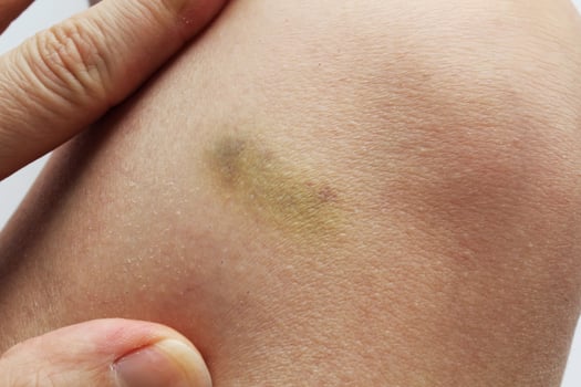 Close-up of woman hand with bruise on the skin. Discoloration and texture of skin clearly visible. Vulnerability and fragility, human body's susceptibility to injury. Concept of health and medicine photo