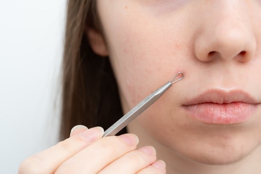 Young woman popping a pimple on a cheek with pimple removal tool. Comedones extractor. Inflamed acne and post-acne marks, redness. Hormonal acne treatment, puberty, adult acne, rosacea. photo