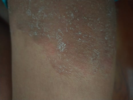ringworm image skin infection photo