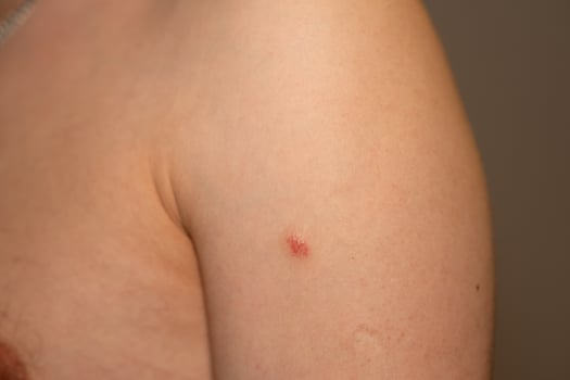 Red, itchy patches on the arm exhibit symptoms commonly associated with psoriasis photo