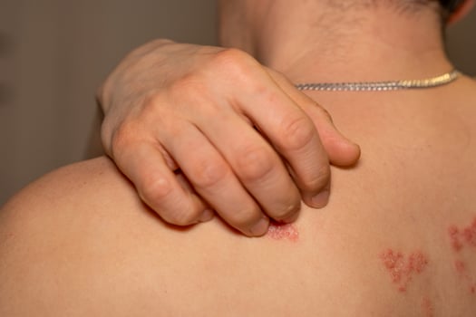 Skin condition affecting shoulder with red patches caused by psoriasis reveals impact on daily life and wellbeing photo
