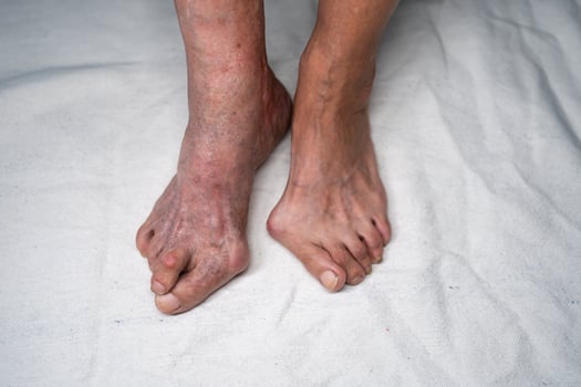 Senior woman feet showing bunion and hallux valgus deformity photo