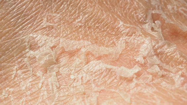 Close up of peeling skin or dry skin. photo