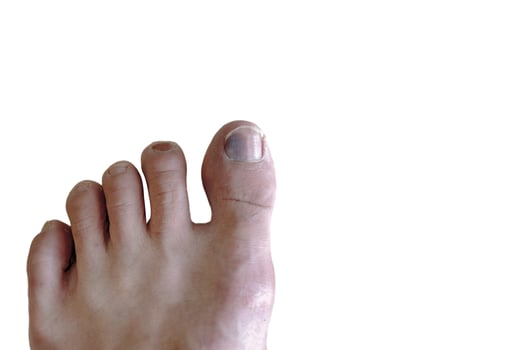 Feet with bruise blood in Toe with fungus photo