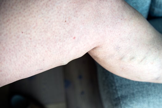 Close up of varicose saphenus vein in a caucasian woman. photo