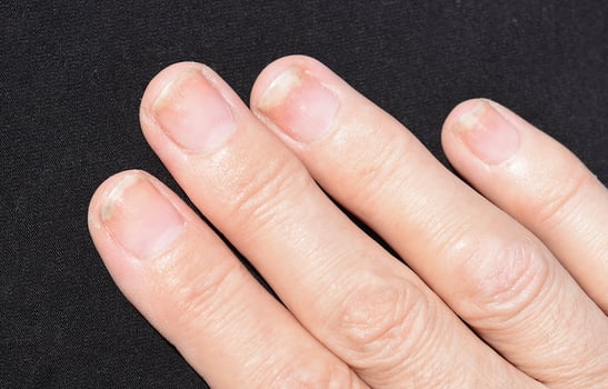 Fungal nail infection onycholysis after shellac or gel varnish. Isolated on white background photo