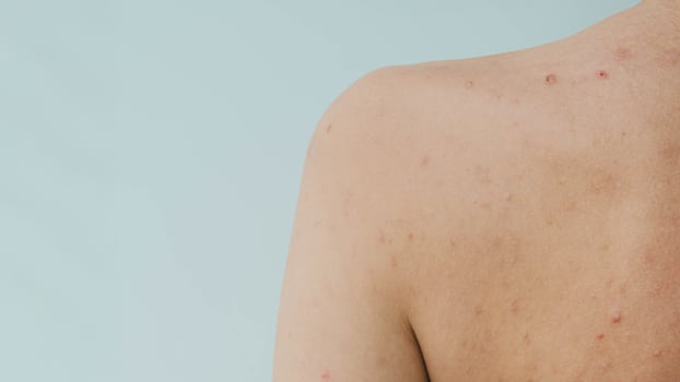 A close-up of a panoramic shot of a woman's skin prone to acne and other dermatological problems. photo