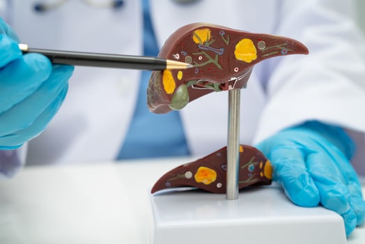 Cirrhosis Liver cancer, fatty liver, Asian doctor with liver human anatomy model in World Hepatitis Day at hospital. photo