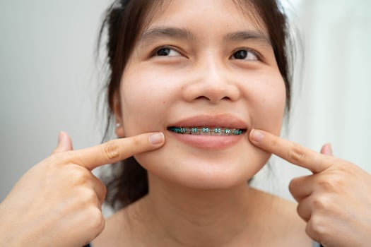 Asian woman with dental braces orthodontic treatment dental care. photo