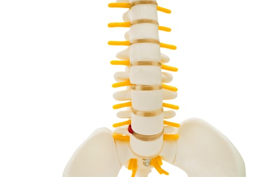 Spinal nerve and bone, Lumbar spine displaced herniated disc fragment, Model for treatment medical in the orthopedic photo
