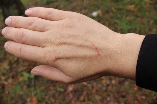 Close up scratch on hand of the back of a young woman's girl's hand photo