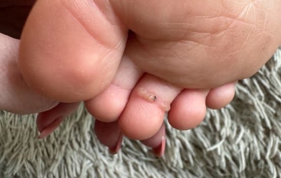 Detailed view of a child's foot featuring a several small wart on one toe. Common skin condition requiring medical attention. photo