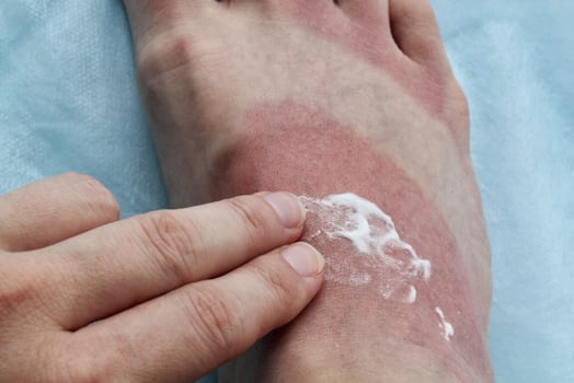 Foot with sunburn and cream application. Person applying cream to sunburned foot. Sunburned feet with topical ointment. Human foot with reddened skin and cream. Treatment of sunburn on foot with cream photo