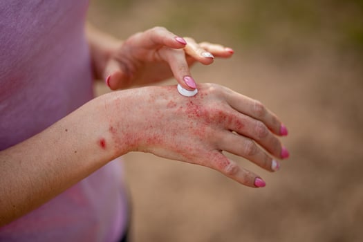 Eczema on the hands. The woman applying the ointment , creams in the treatment of eczema, psoriasis and other skin diseases. Skin problem concept photo