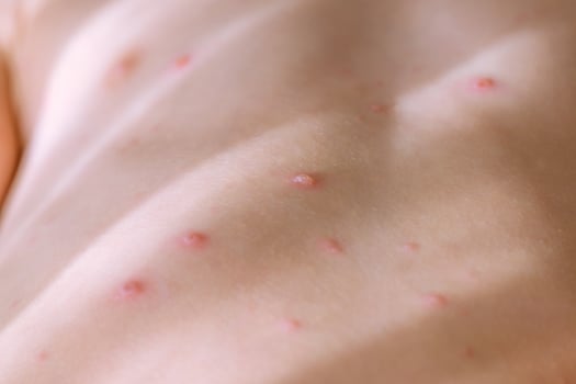 Chickenpox blisters on body of child photo