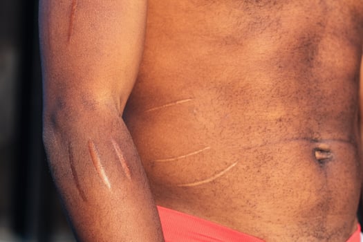 Crop man with scars on body photo