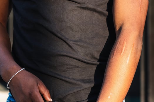 Faceless black person with scars on arm photo