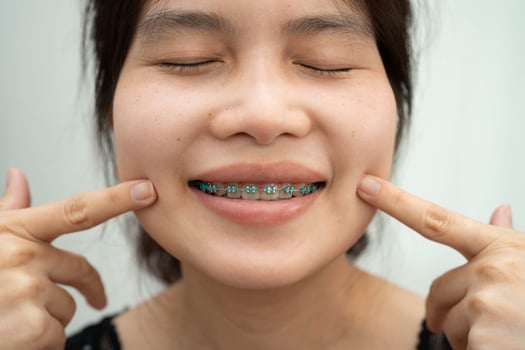 Asian woman with dental braces orthodontic treatment dental care. photo