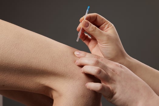 concept dry needling method. Acupuncture treatment close-up. Therapist inserting a thin needle into patient's skin for alternative therapy, pain relief, and wellness. photo
